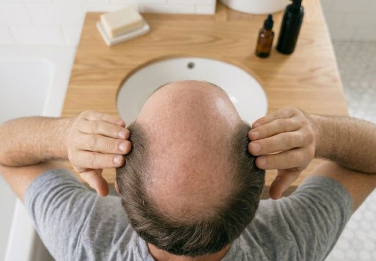 A man with androgenetic alopecia