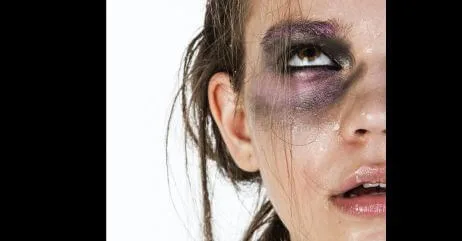 A woman with black eye as a result of toxic masculinity